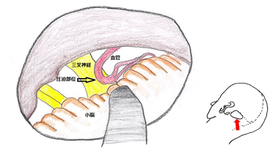 図１　三叉神経痛の手術所見図　三叉神経に脳血管が圧迫している