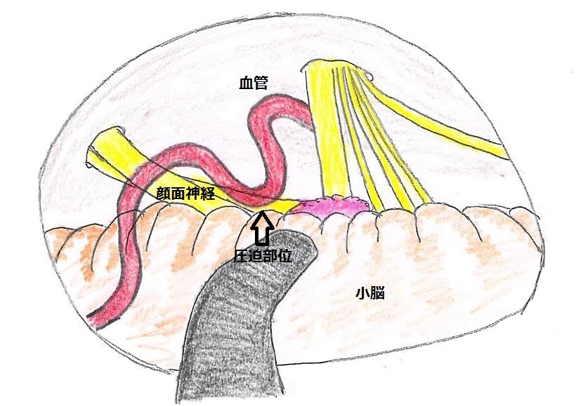 図１B　片側顔面けいれんの手術所見図　顔面神経に脳血管が圧迫している