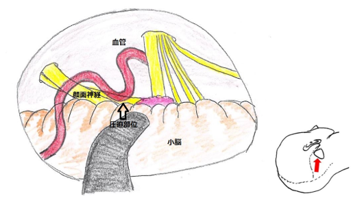図１B　片側顔面けいれんの手術所見図　顔面神経に脳血管が圧迫している