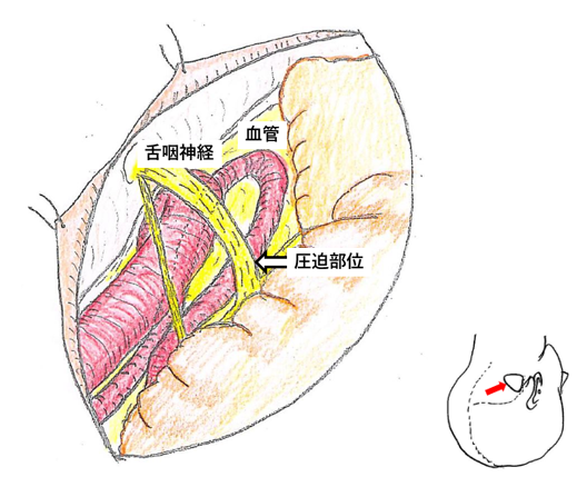 図１　舌咽神経痛の手術図　舌咽神経に脳血管が圧迫している