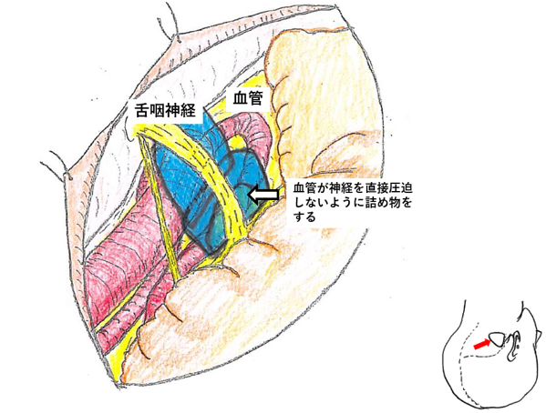 図２C　舌咽神経痛の手術図　神経と血管の間に詰め物（テフロンなど）を置き、神経に血管が直接圧迫しないようにした